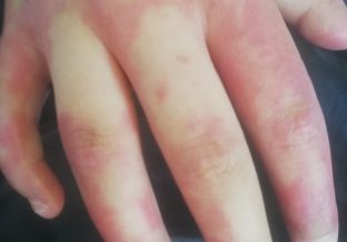 ręka z poparzeniami od chemioterapii